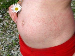 Последствия атопического дерматита при беременности