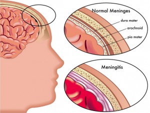 Менингит при беременности симптом головная боль