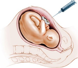 Отслойка плаценты на поздних сроках беременности
