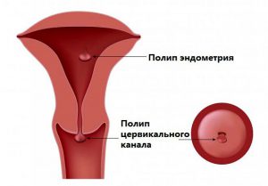 Полип в цервикальном канале при беременности