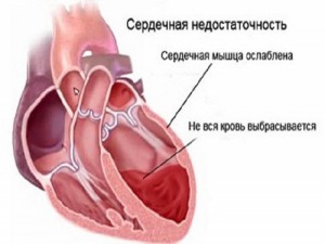 Течение беременности при сердечной недостаточности