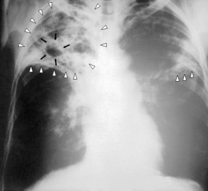 Туберкулёз во время беременности